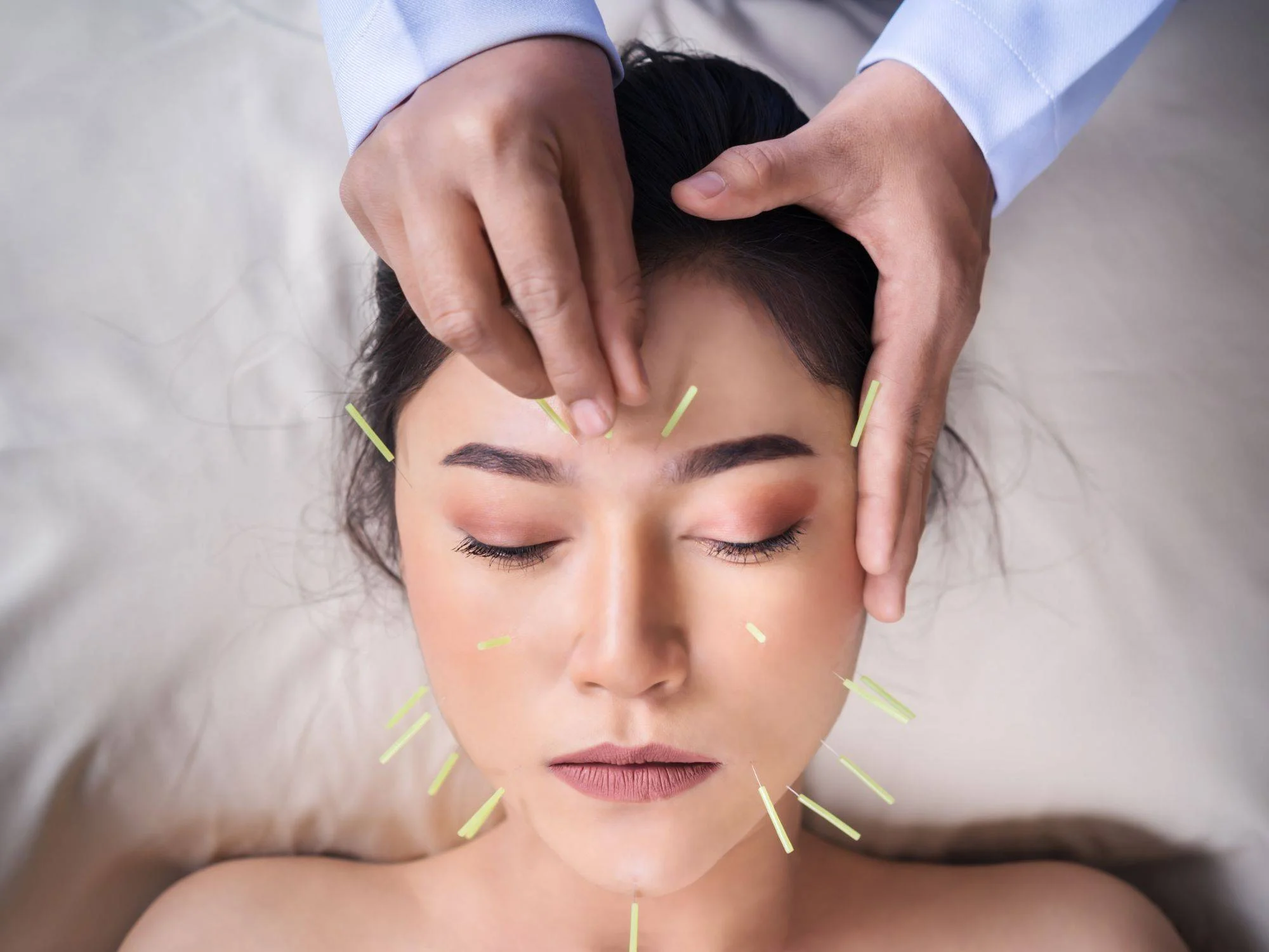 Woman receiving facial acupuncture treatment with needles on her face.